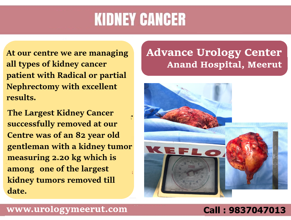 Kidney Cancer Treatment in Meerut